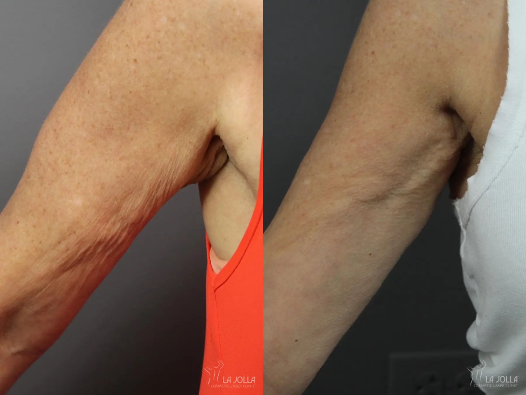 Radiesse®: Patient 2 - Before and After 1