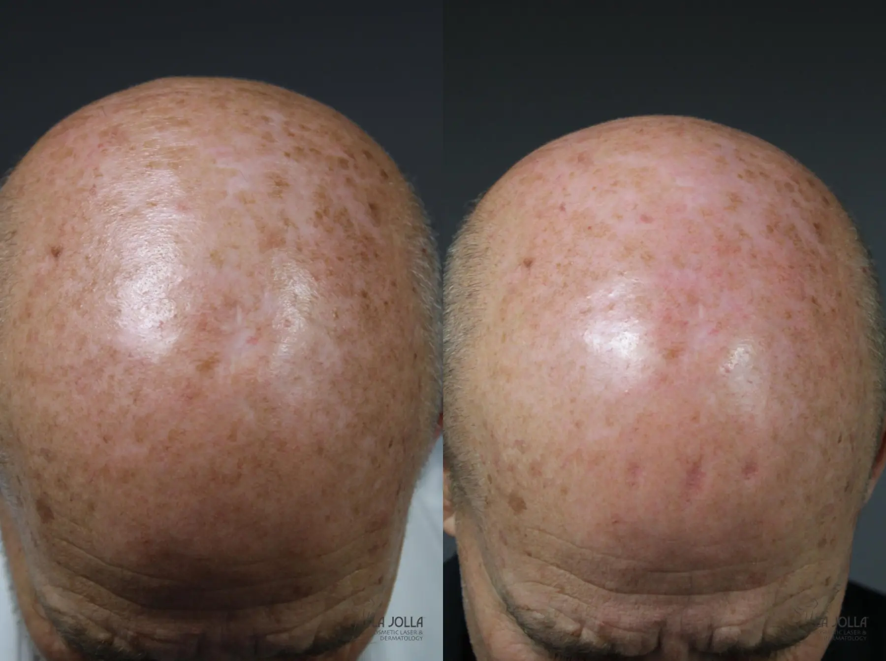 Radiesse®: Patient 1 - Before and After  