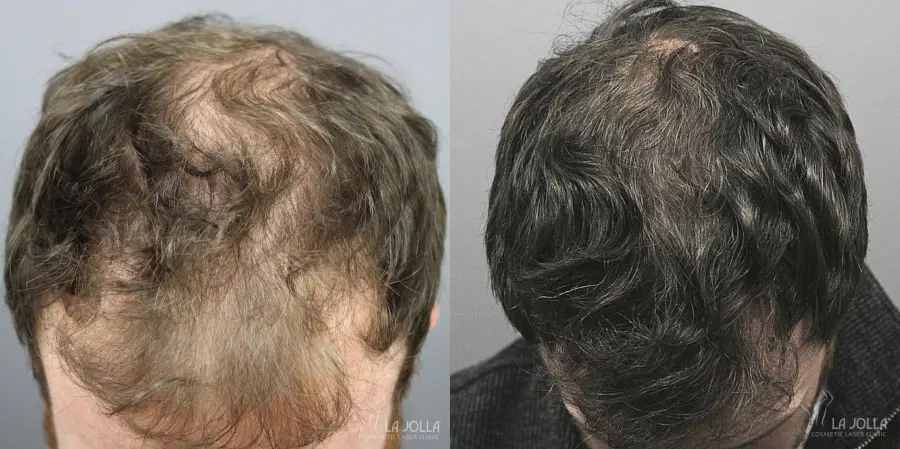 Regenerative Medicine: Patient 1 - Before and After  
