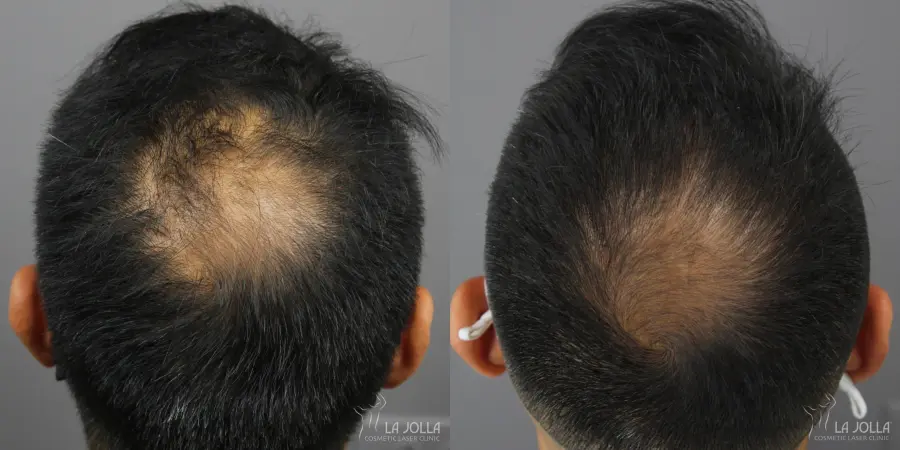 Regenerative Medicine: Patient 7 - Before and After  