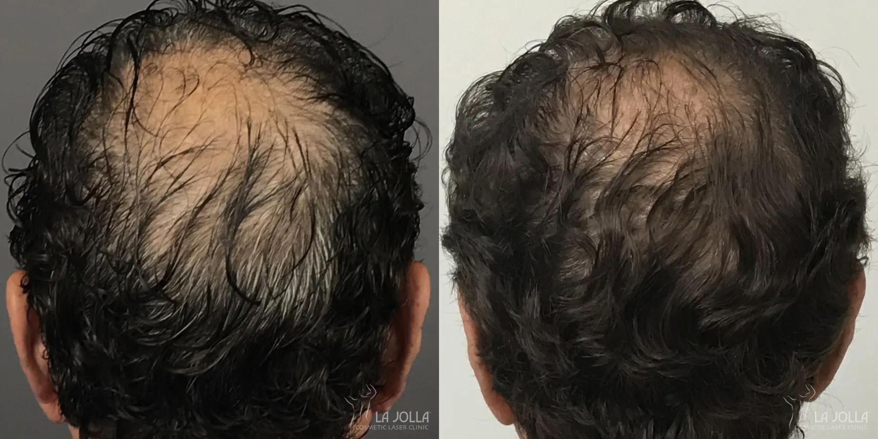 Regenerative Medicine: Patient 3 - Before and After 1