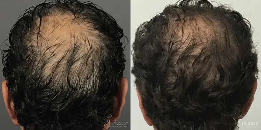 Regenerative Medicine: Patient 2 - Before and After  