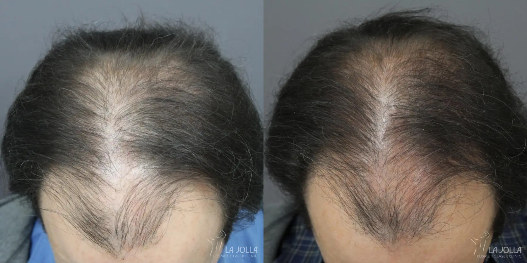 Regenerative Medicine: Patient 4 - Before and After 1