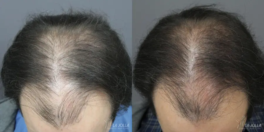 Regenerative Medicine: Patient 3 - Before and After  