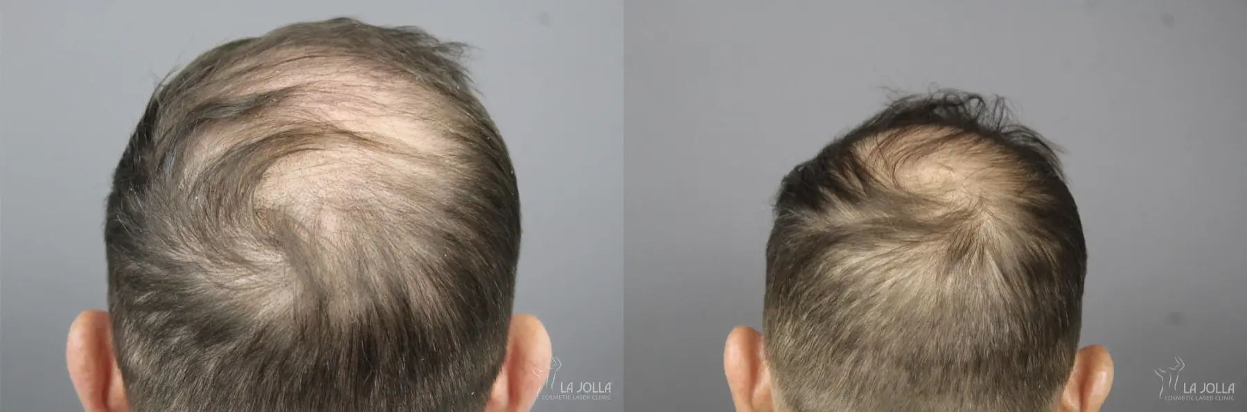 Regenerative Medicine: Patient 1 - Before and After 1