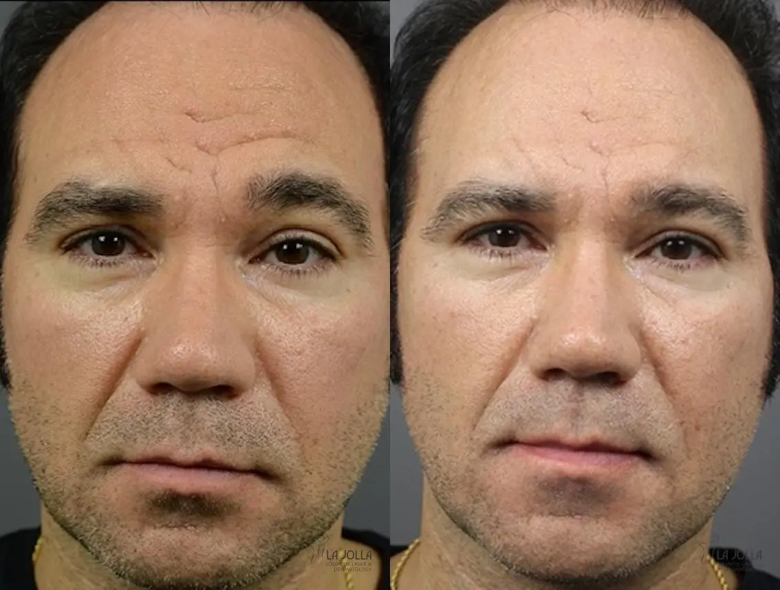 ResurFX: Patient 5 - Before and After 1