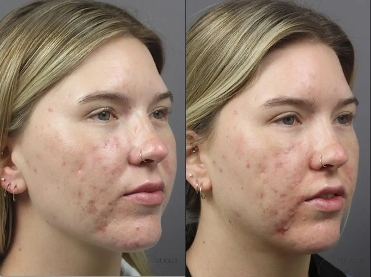 ResurFX: Patient 3 - Before and After 3