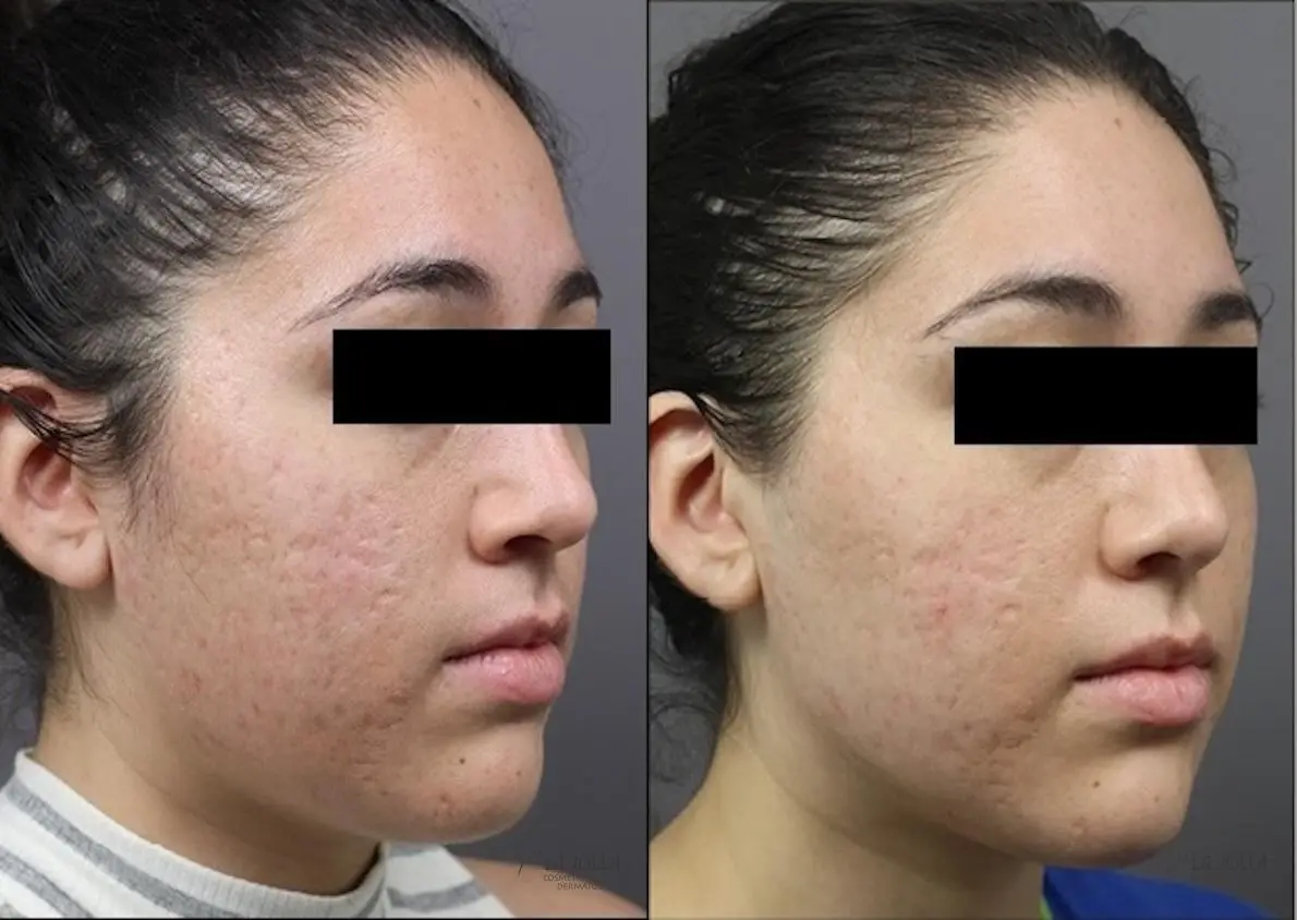 ResurFX: Patient 8 - Before and After 1