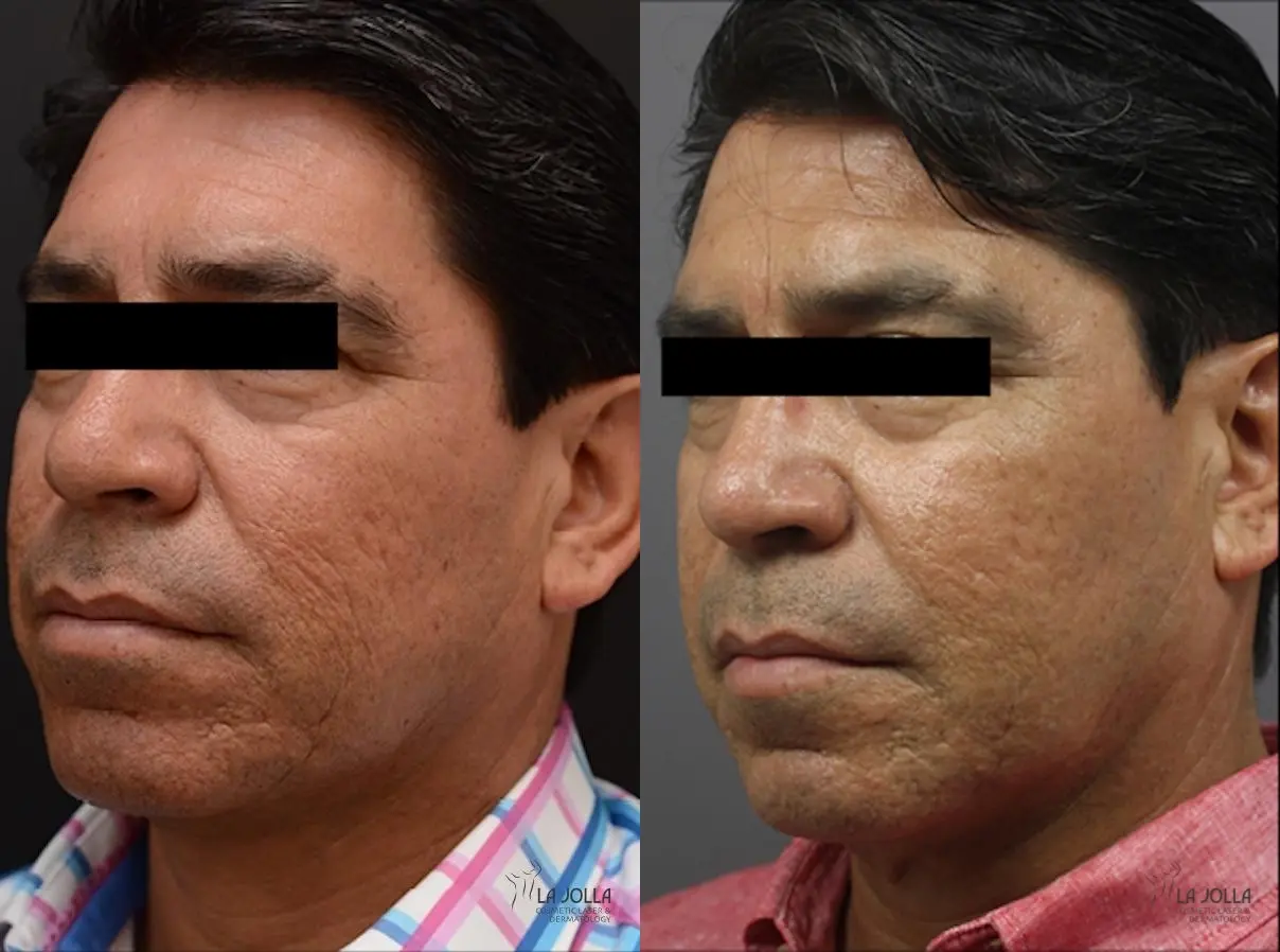 ResurFX: Patient 2 - Before and After 2