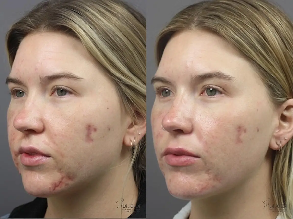 ResurFX: Patient 3 - Before and After 2