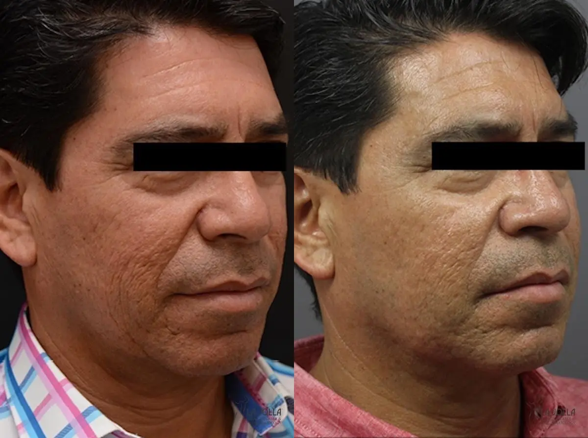 ResurFX: Patient 2 - Before and After 3