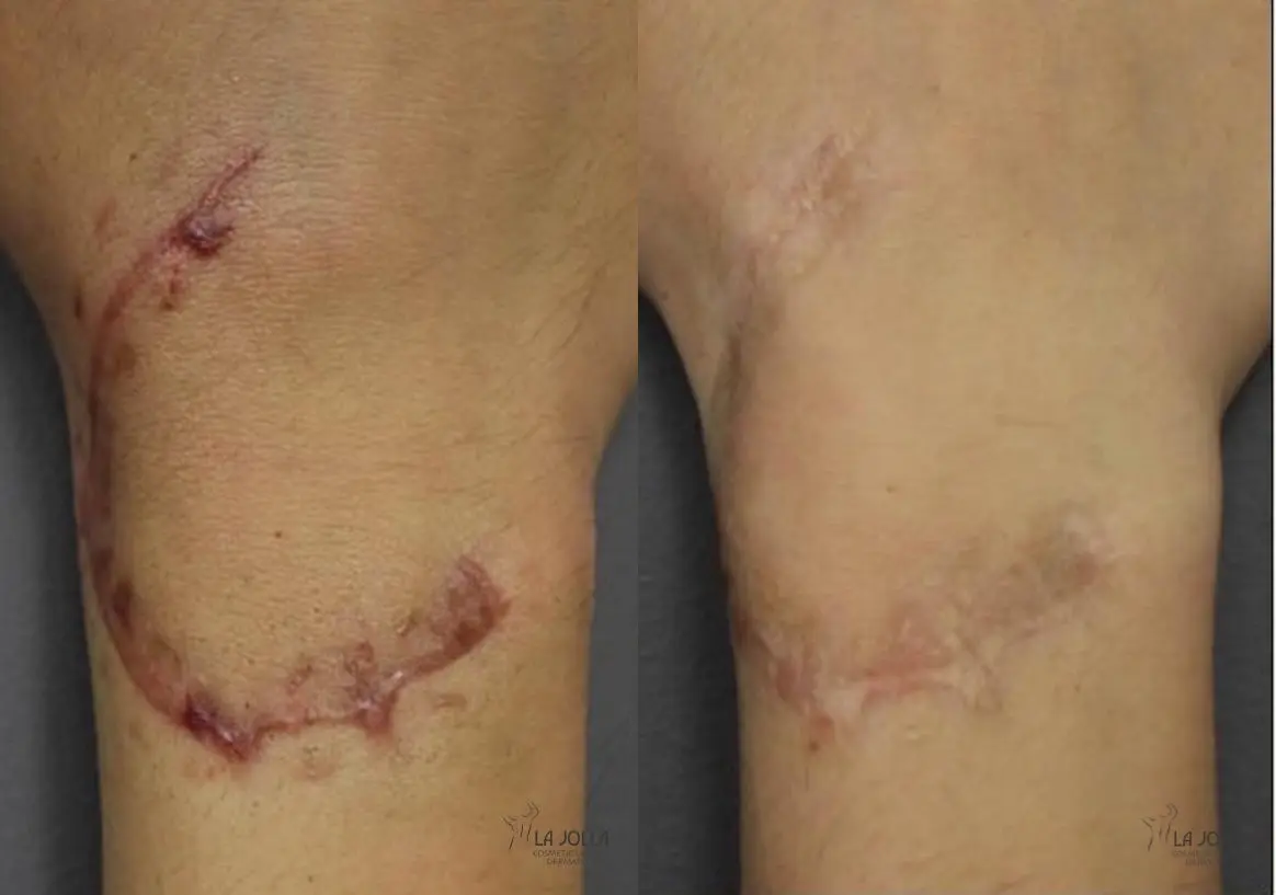 ResurFX: Patient 1 - Before and After 1