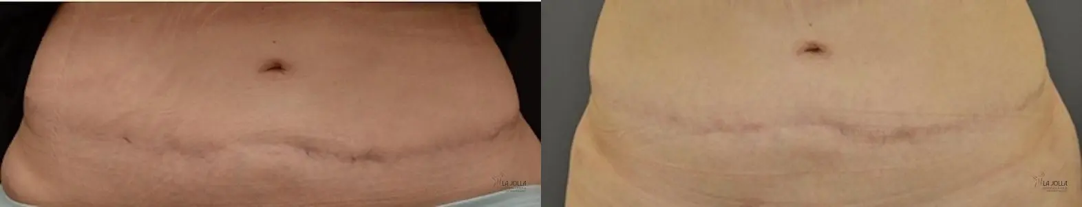 ResurFX: Patient 10 - Before and After 1