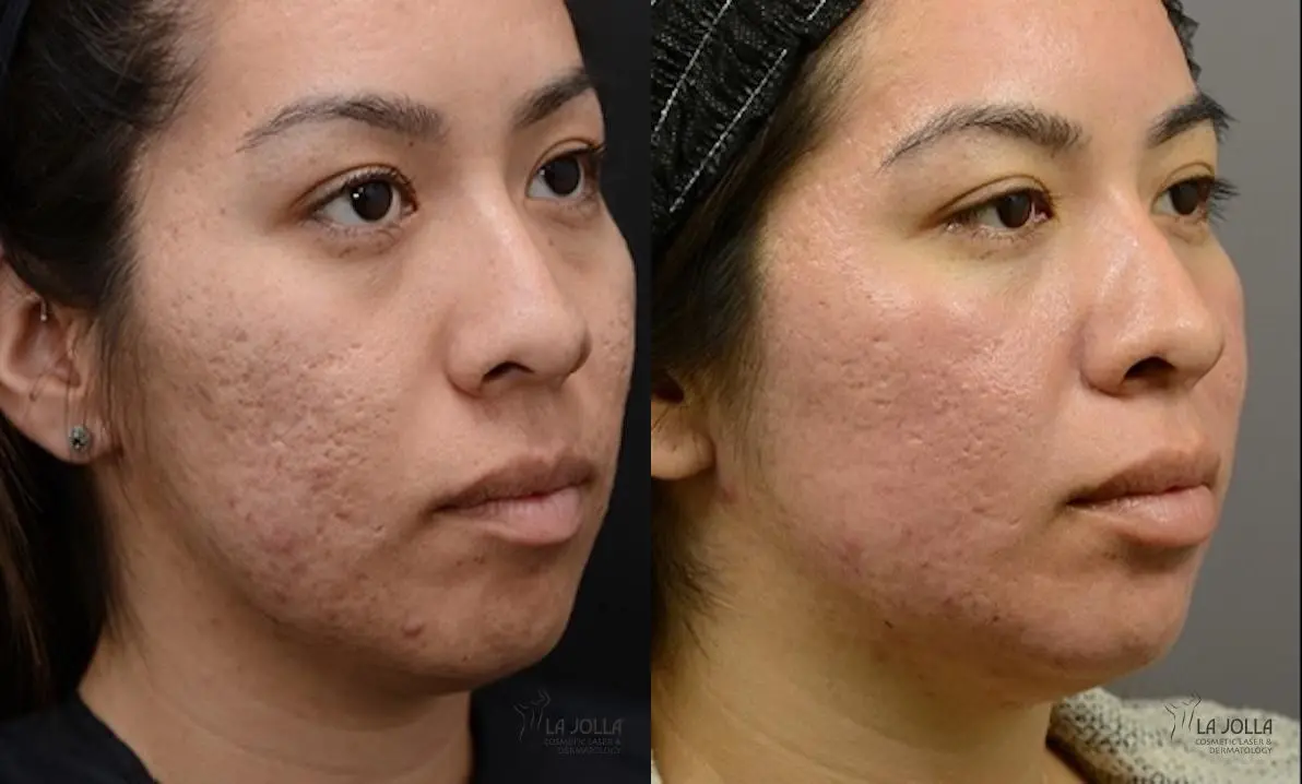 ResurFX: Patient 11 - Before and After 1