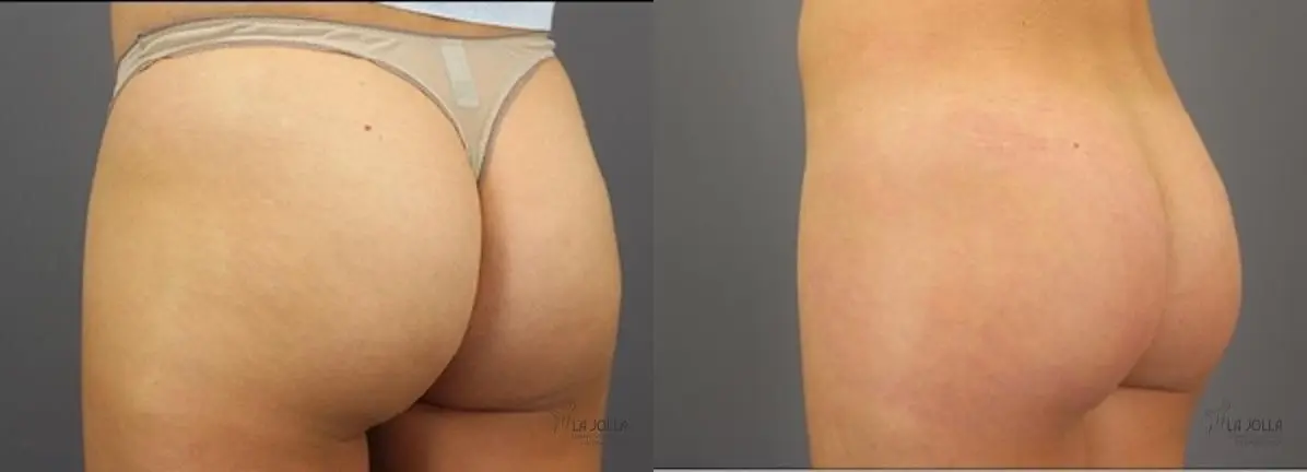 ResurFX: Patient 6 - Before and After 1