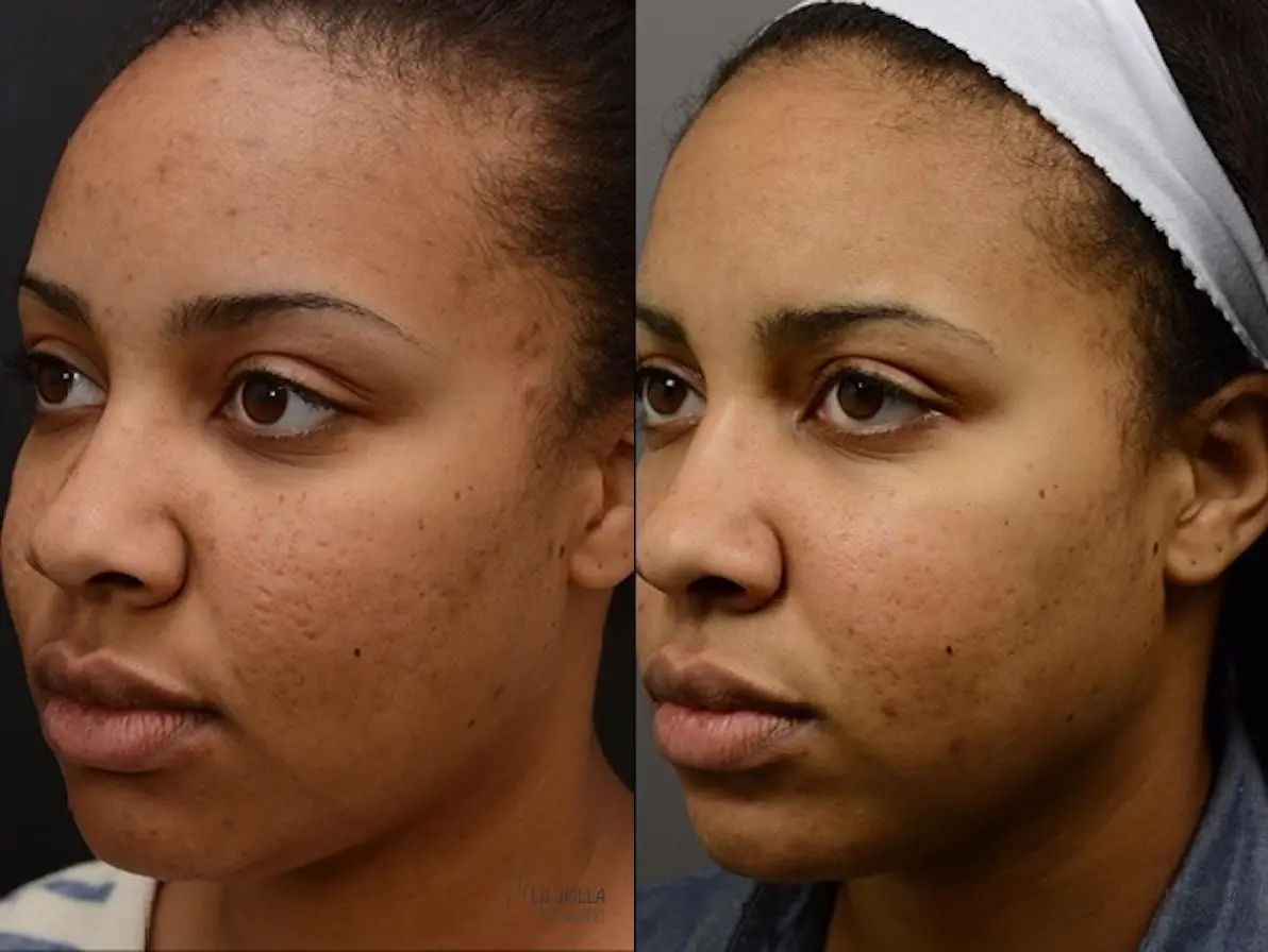 ResurFX: Patient 9 - Before and After 1