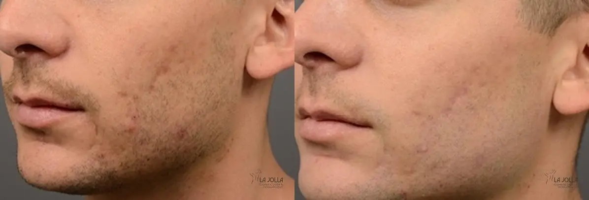 ResurFX: Patient 12 - Before and After 1