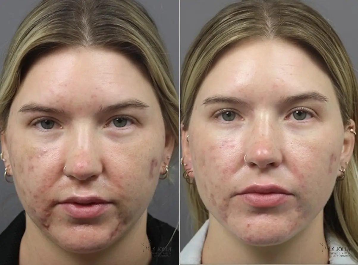 ResurFX: Patient 3 - Before and After 1