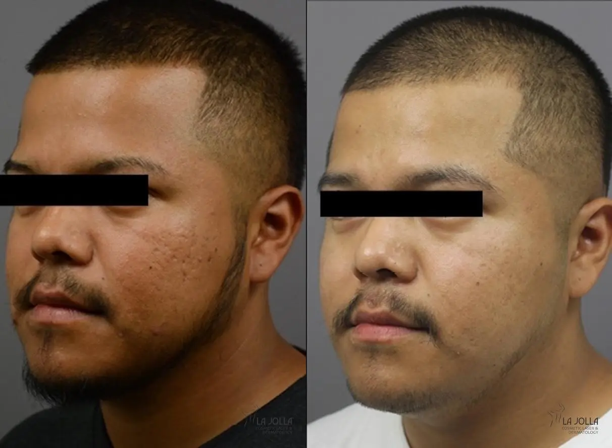 ResurFX: Patient 4 - Before and After 1