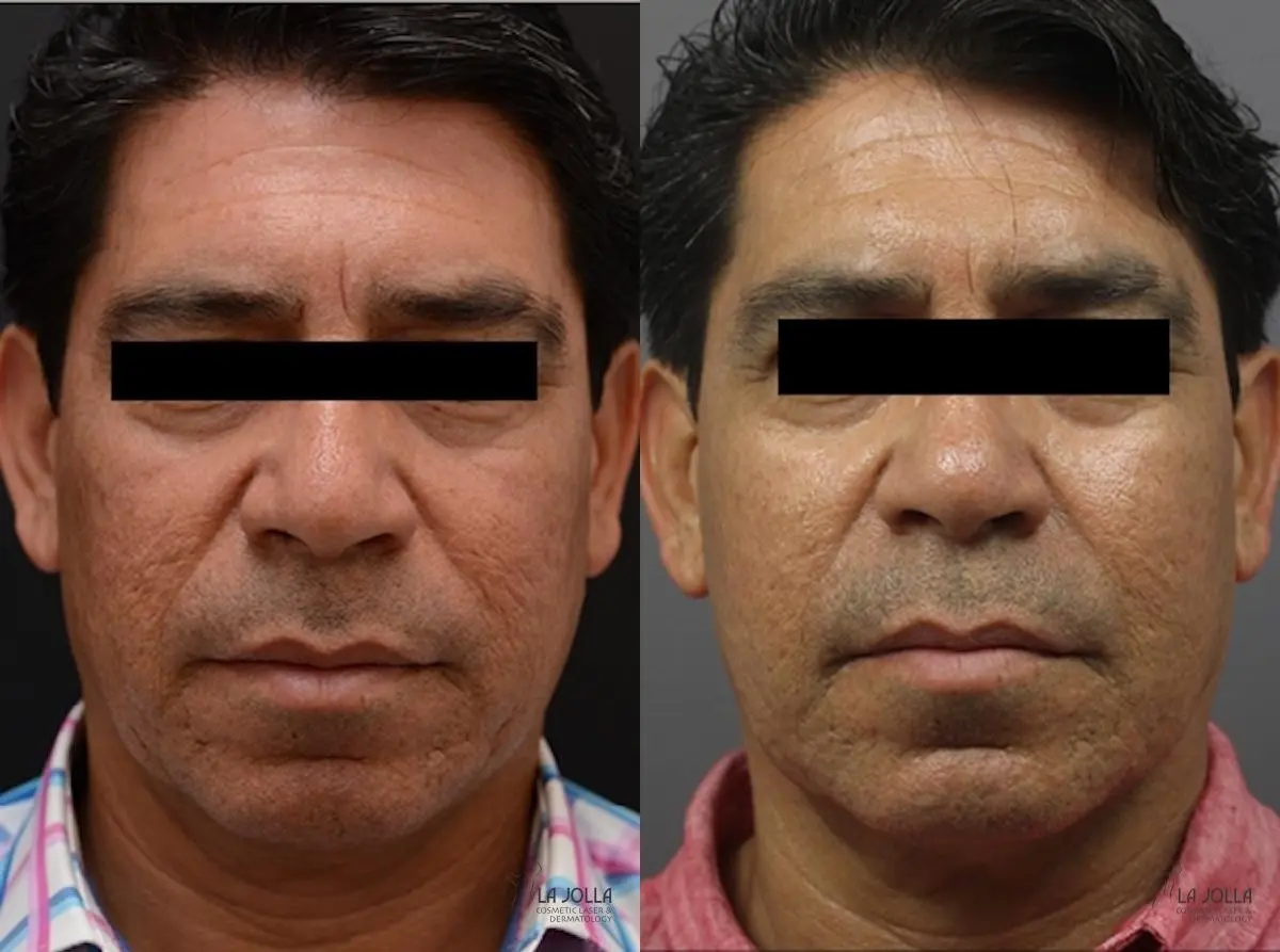 ResurFX: Patient 2 - Before and After 1