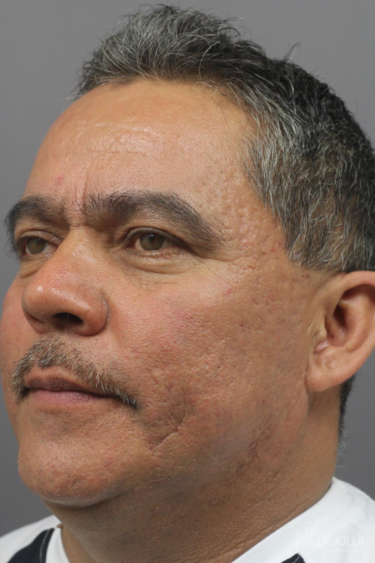 Treat Acne Scars In San Diego La Jolla Cosmetic Laser Center