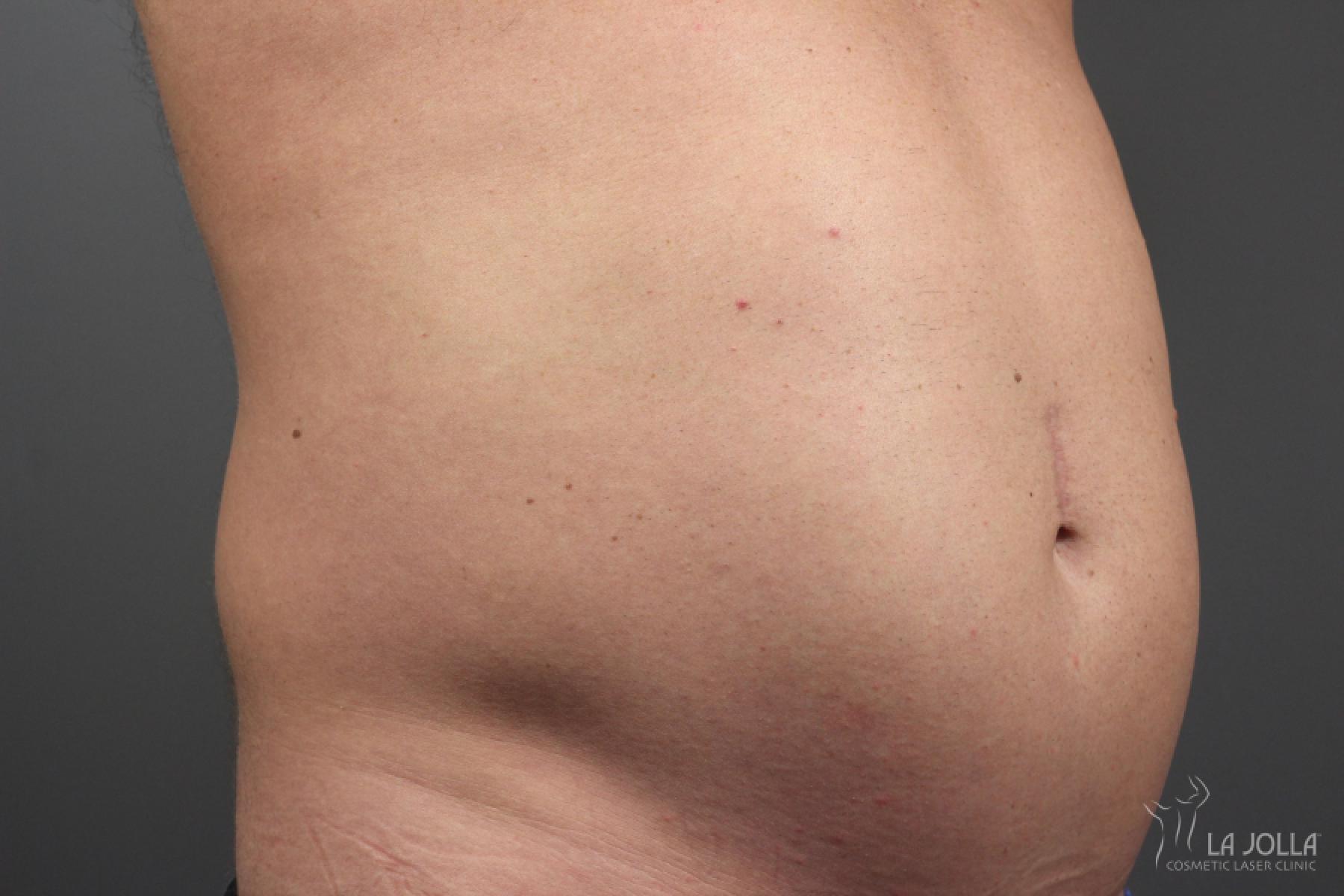 CoolSculpting®: Patient 13 - Before 1