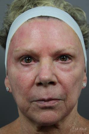 Liquid Facelift: Patient 6 - Before 