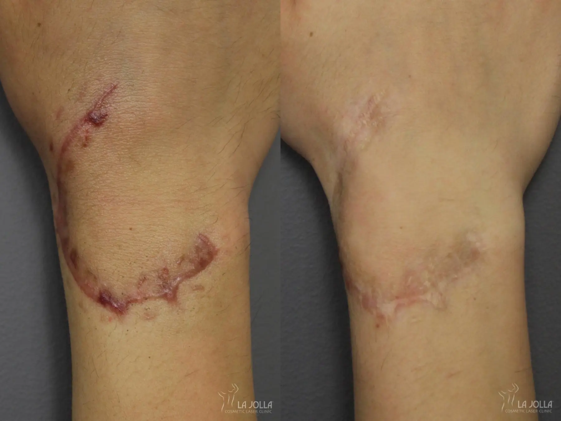 Scars: Patient 1 - Before and After 1