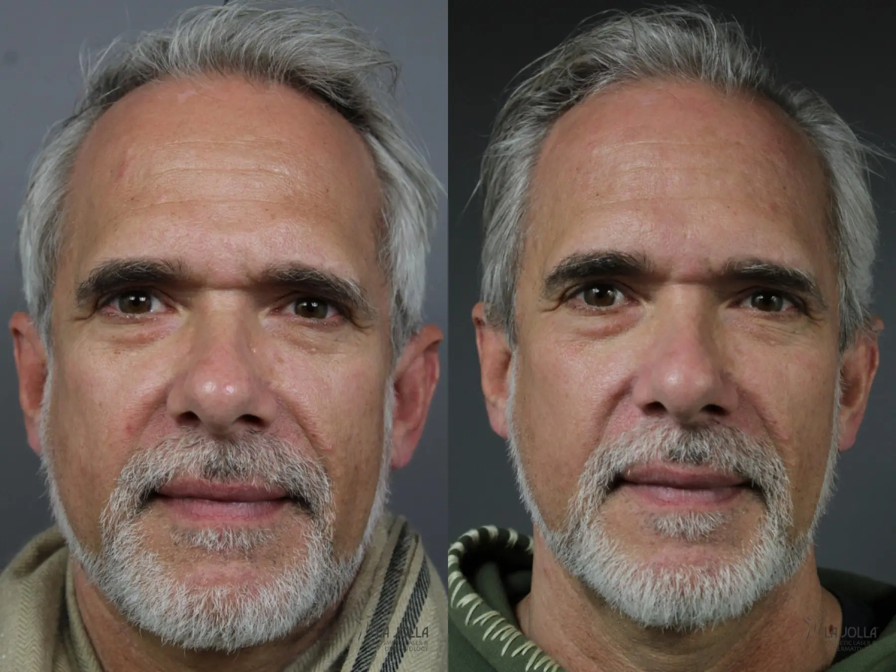 Sculptra®: Patient 1 - Before and After 1