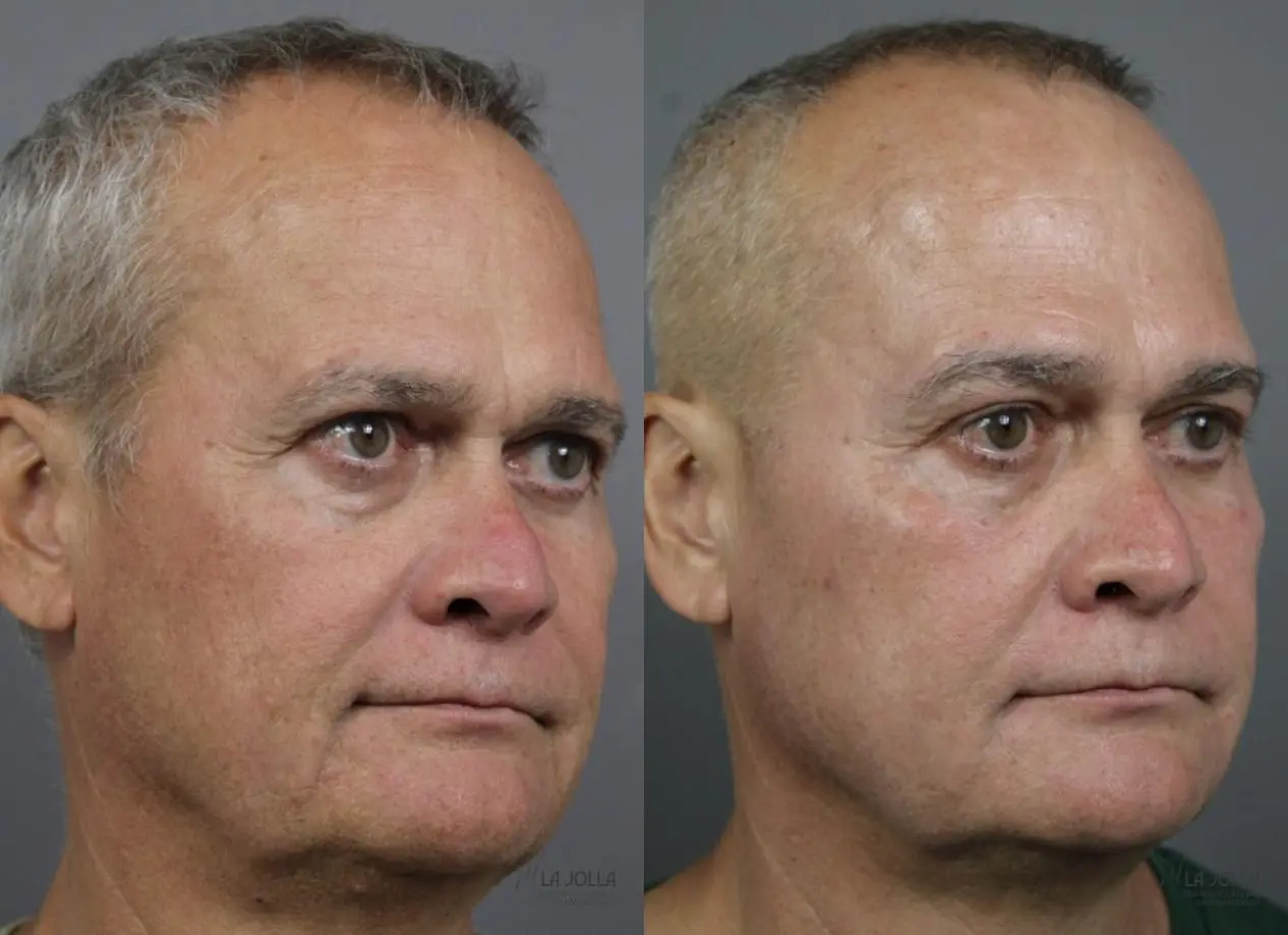 Sculptra®: Patient 2 - Before and After 2