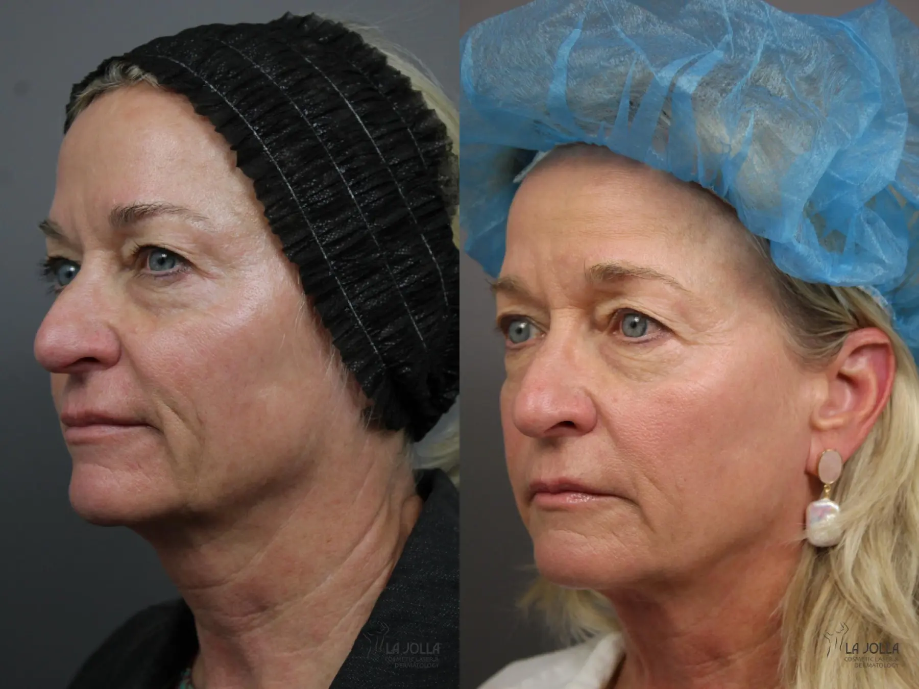 Sculptra®: Patient 1 - Before and After 2