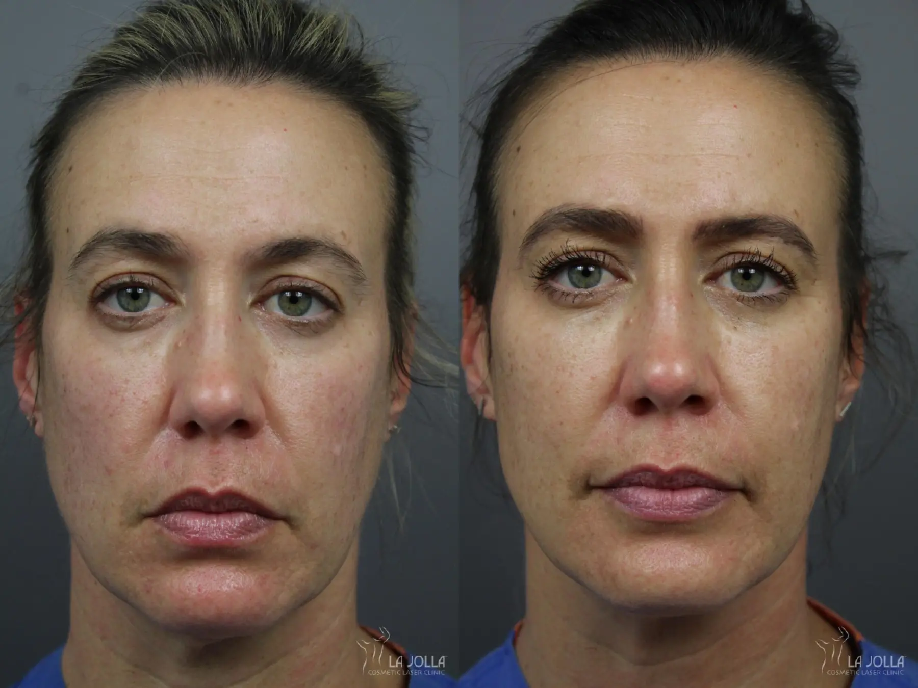 Sculptra®: Patient 18 - Before and After 1