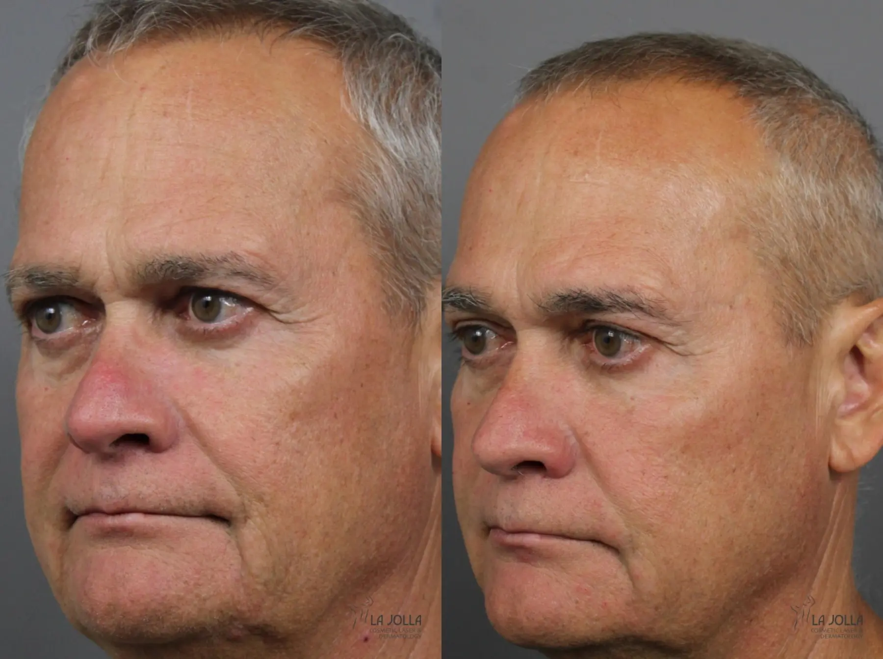 Sculptra®: Patient 3 - Before and After 2