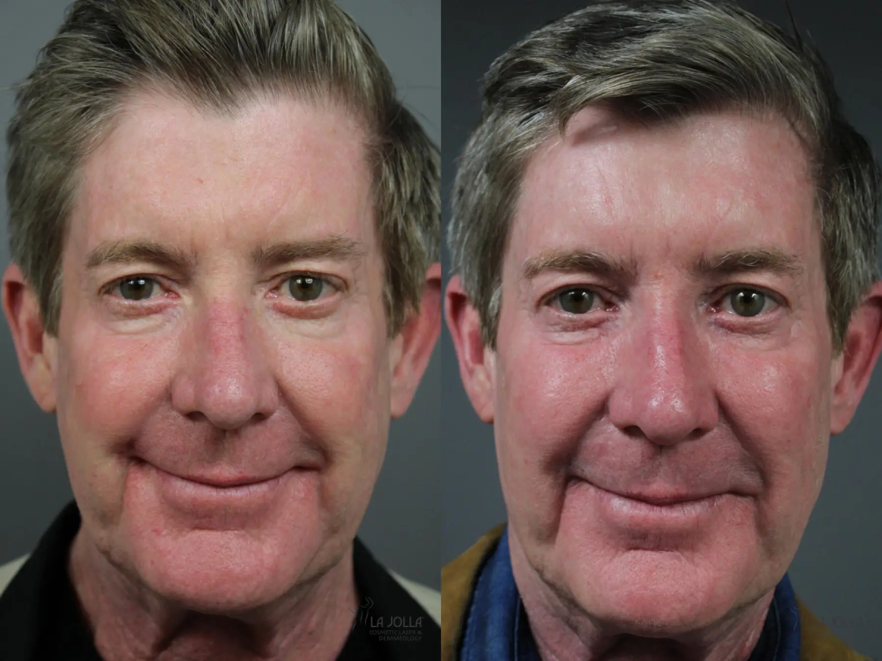 Sculptra®: Patient 2 - Before and After 1