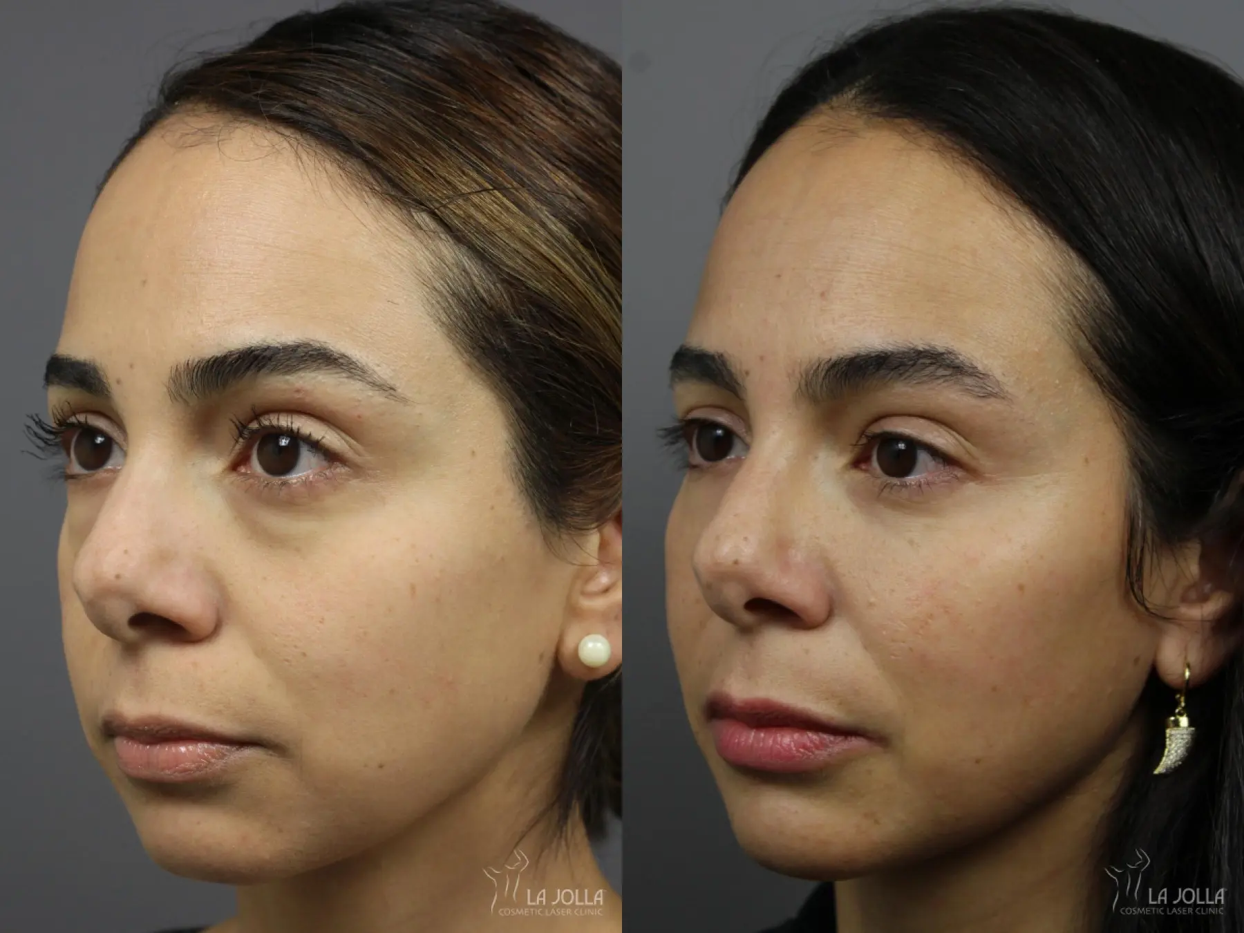 Sculptra®: Patient 13 - Before and After 2