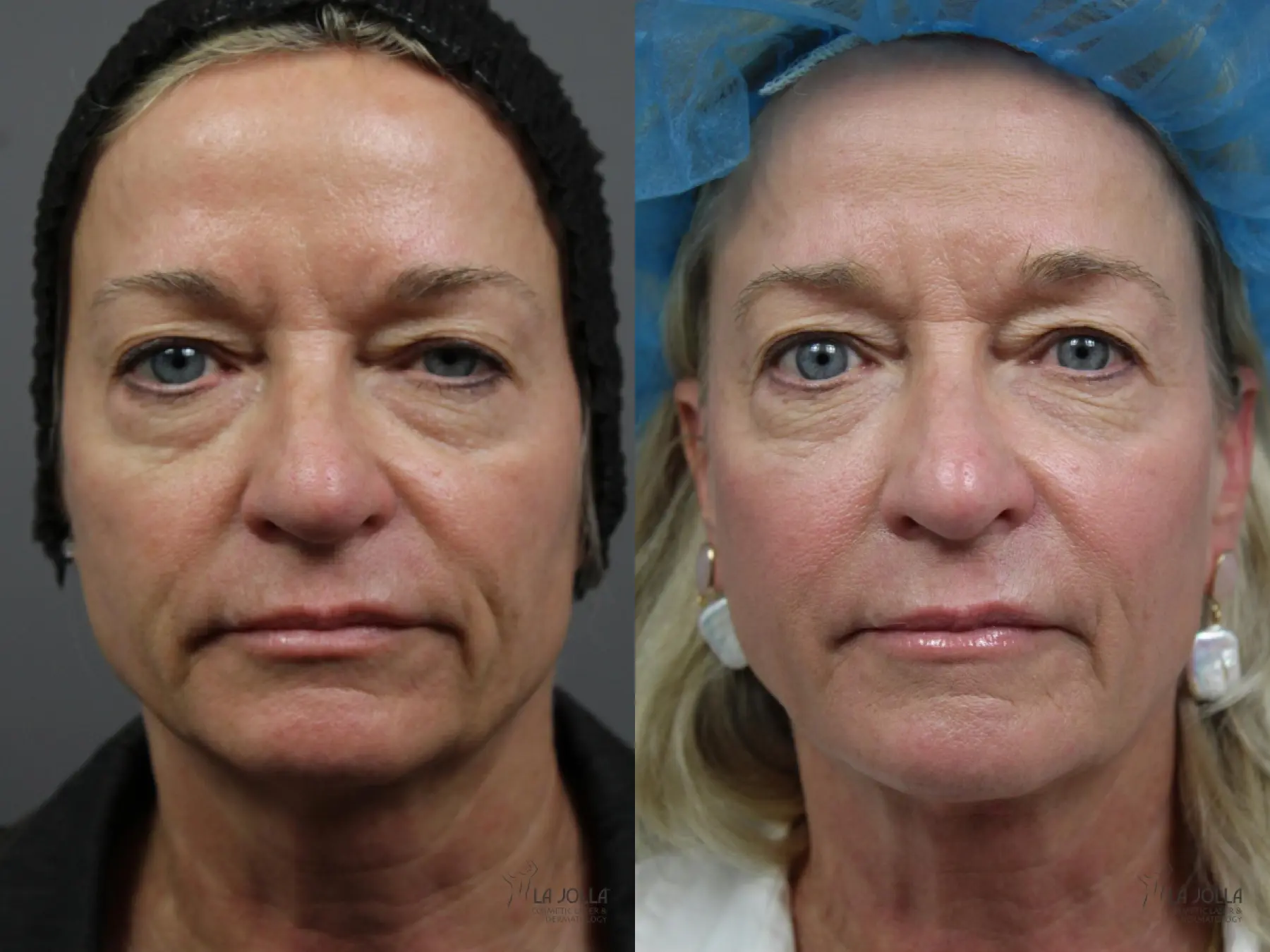 Sculptra®: Patient 1 - Before and After 1