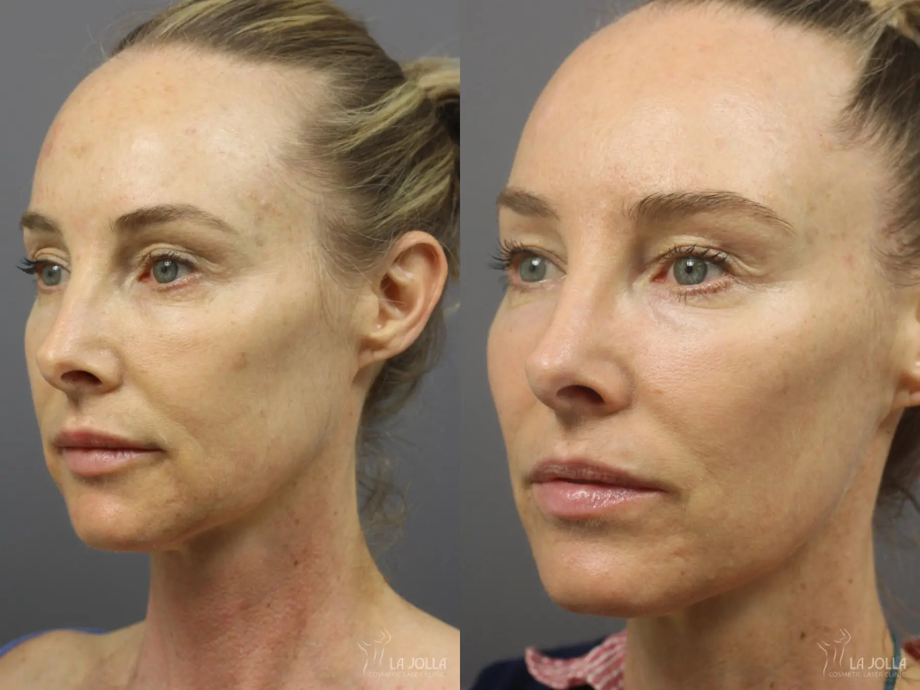 Sculptra®: Patient 21 - Before and After 1