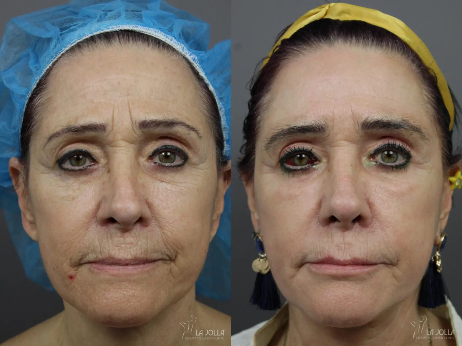 Sculptra®: Patient 10 - Before and After  