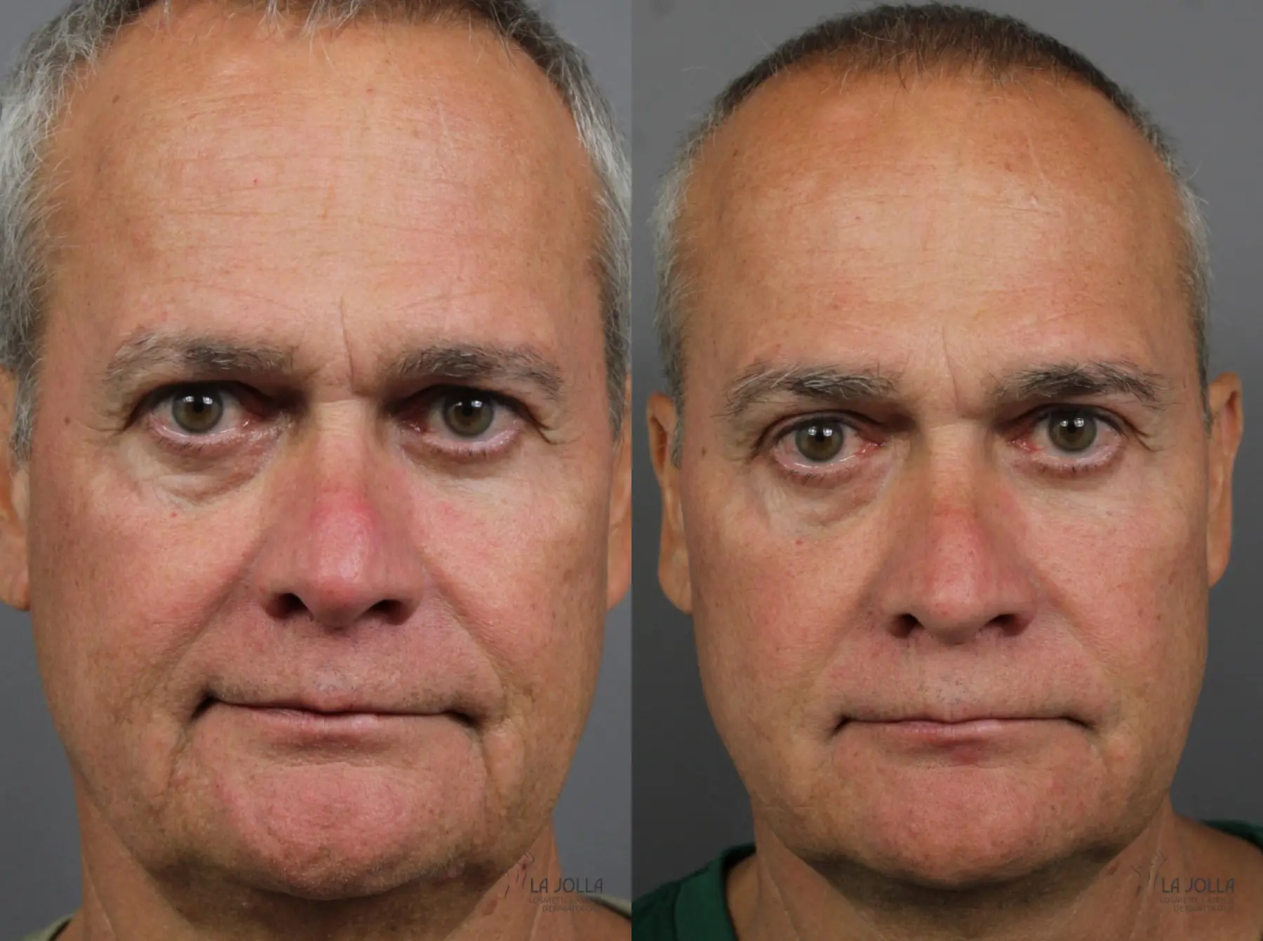 Sculptra®: Patient 3 - Before and After 1