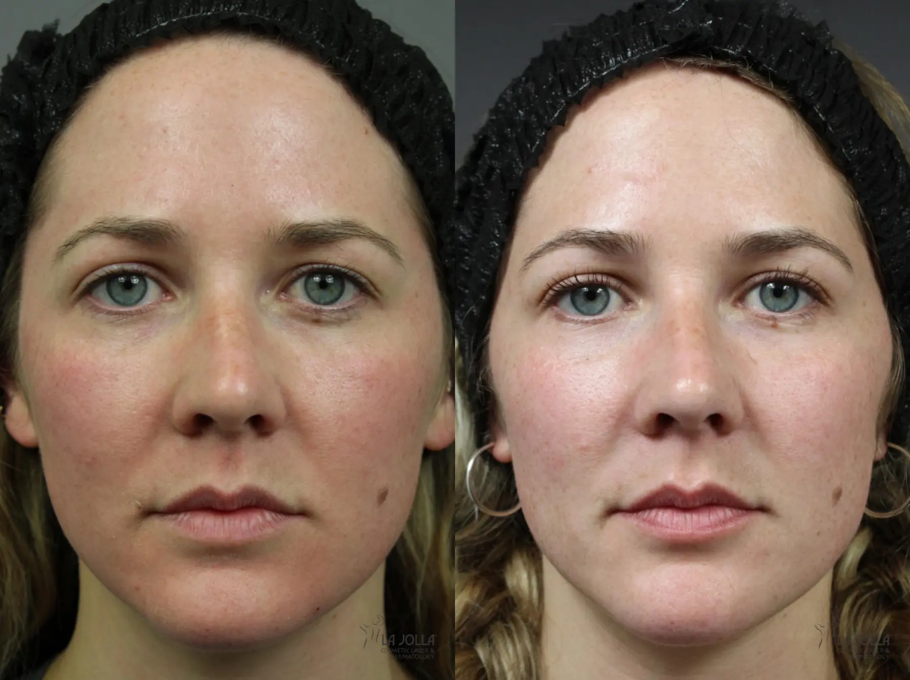 Sculptra®: Patient 1 - Before and After 1