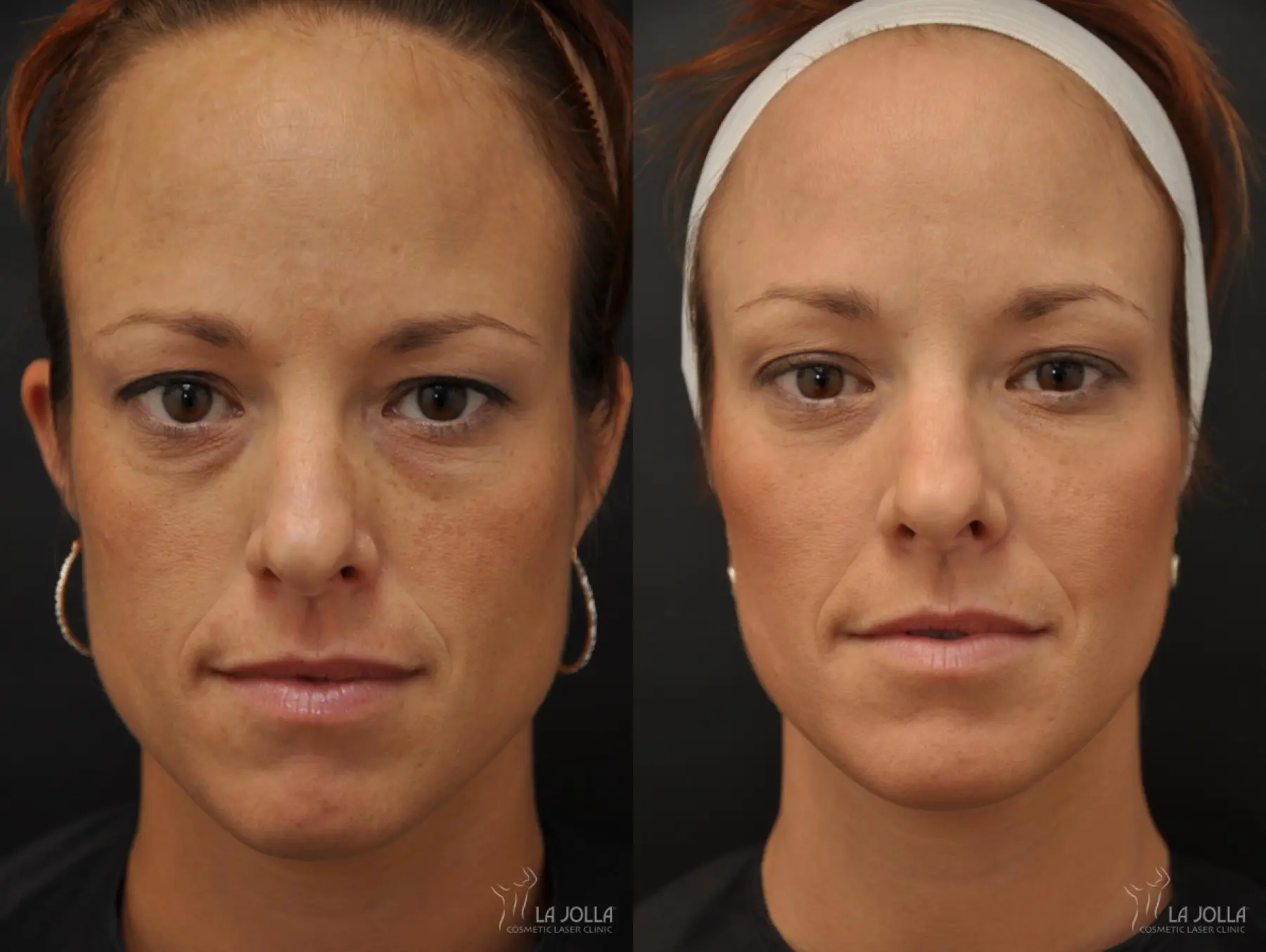 Sculptra®: Patient 20 - Before and After 1