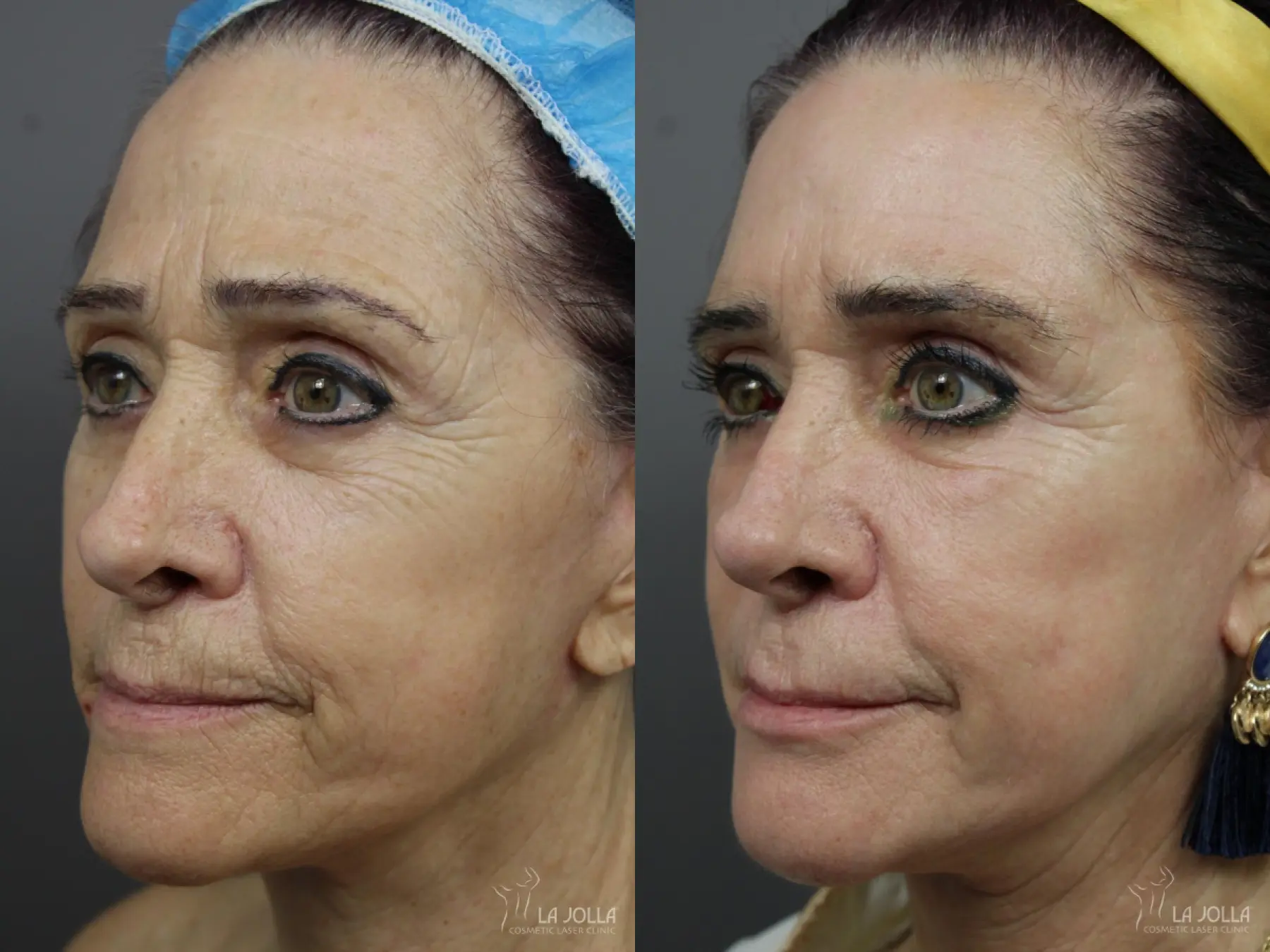 Sculptra®: Patient 11 - Before and After 2