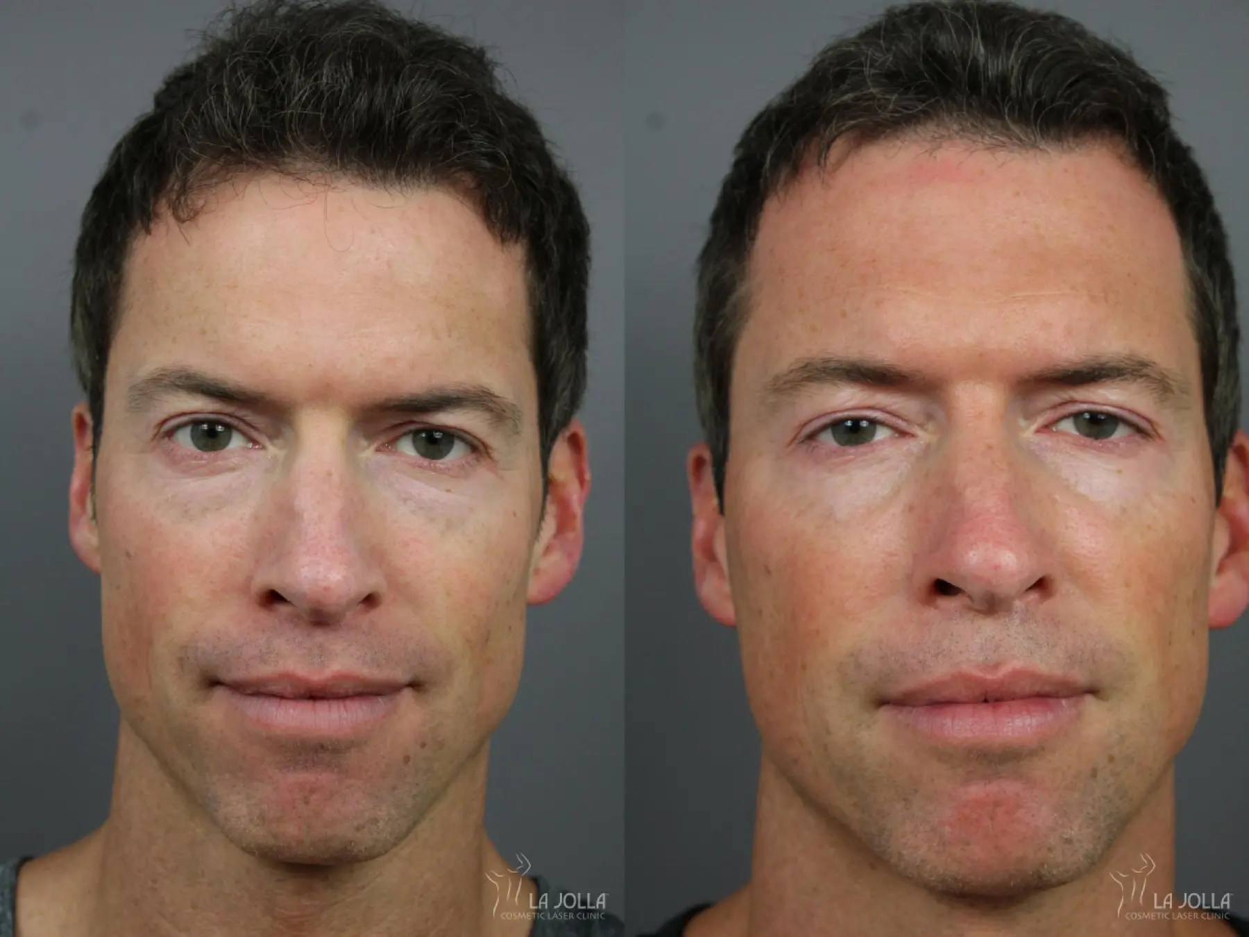 Sculptra®: Patient 16 - Before and After 1