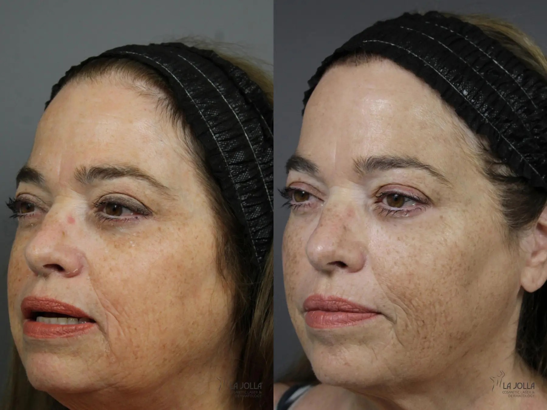 Sculptra®: Patient 1 - Before and After 2