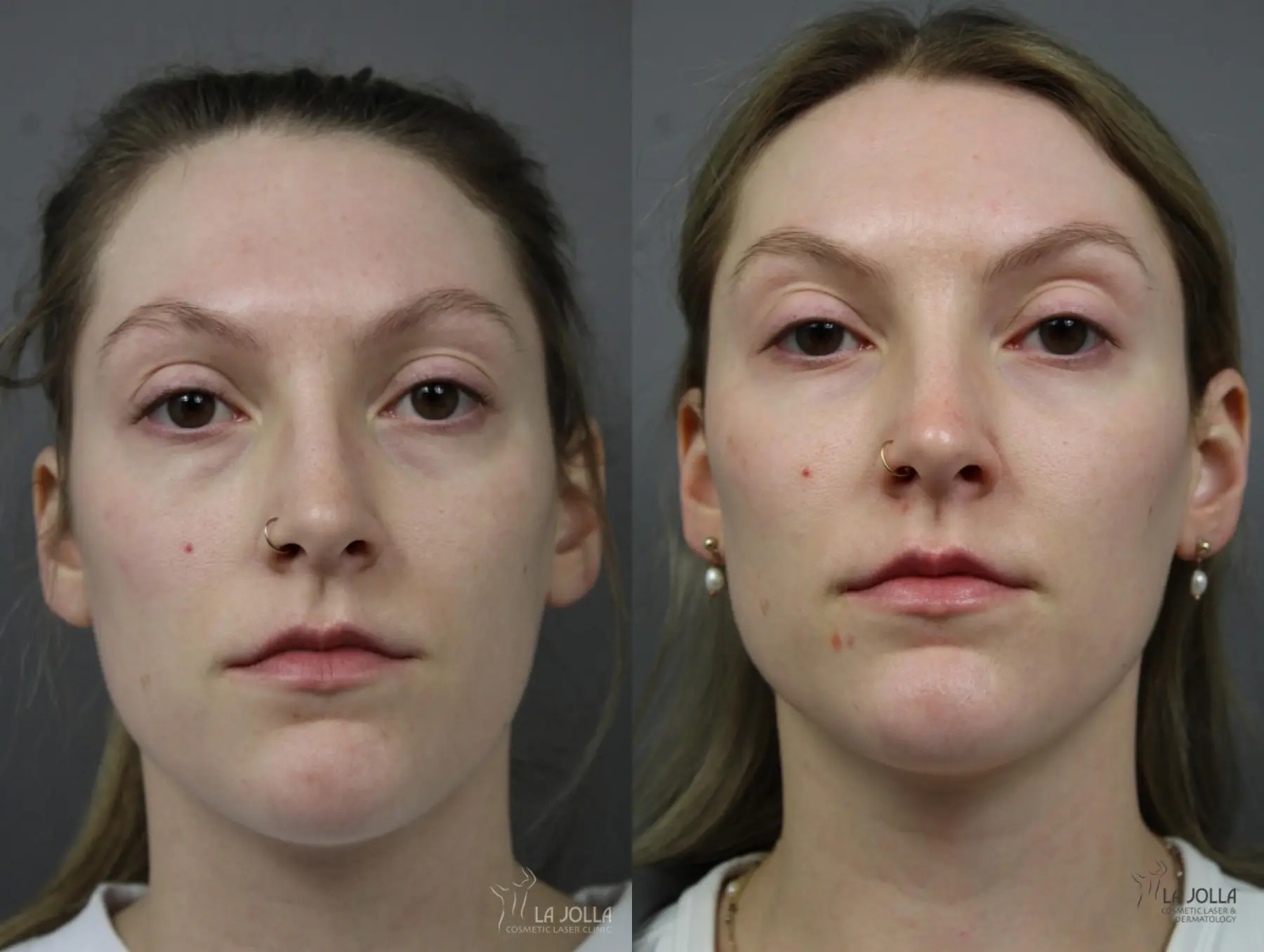 Sculptra®: Patient 2 - Before and After 1