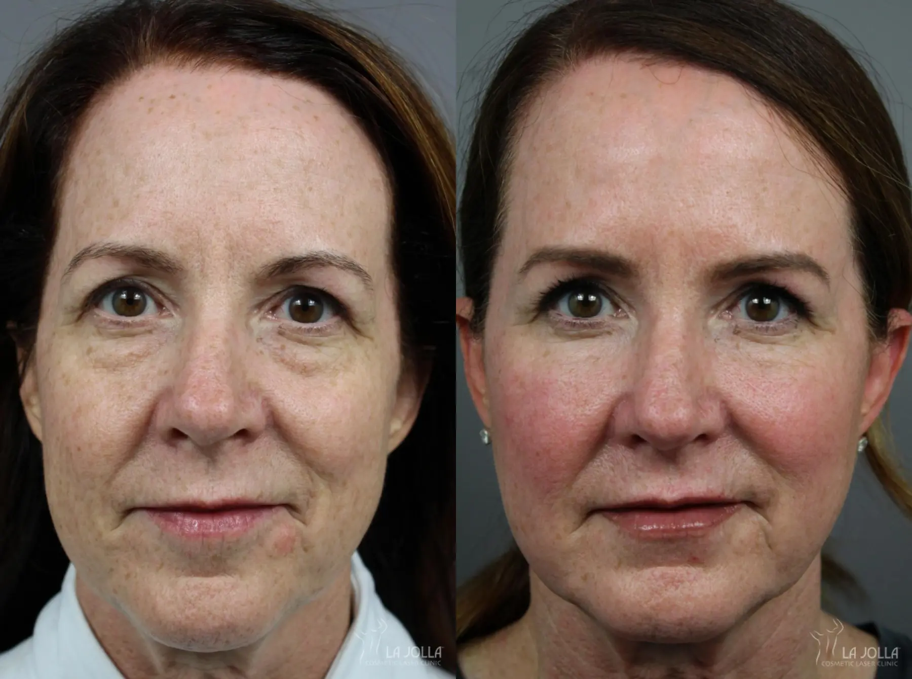 Sculptra®: Patient 5 - Before and After  