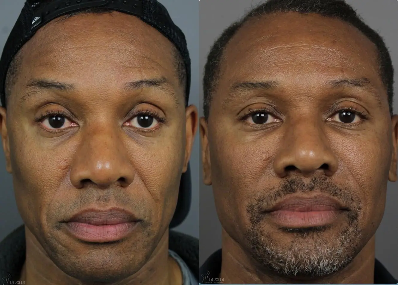 Sculptra®: Patient 1 - Before and After 1