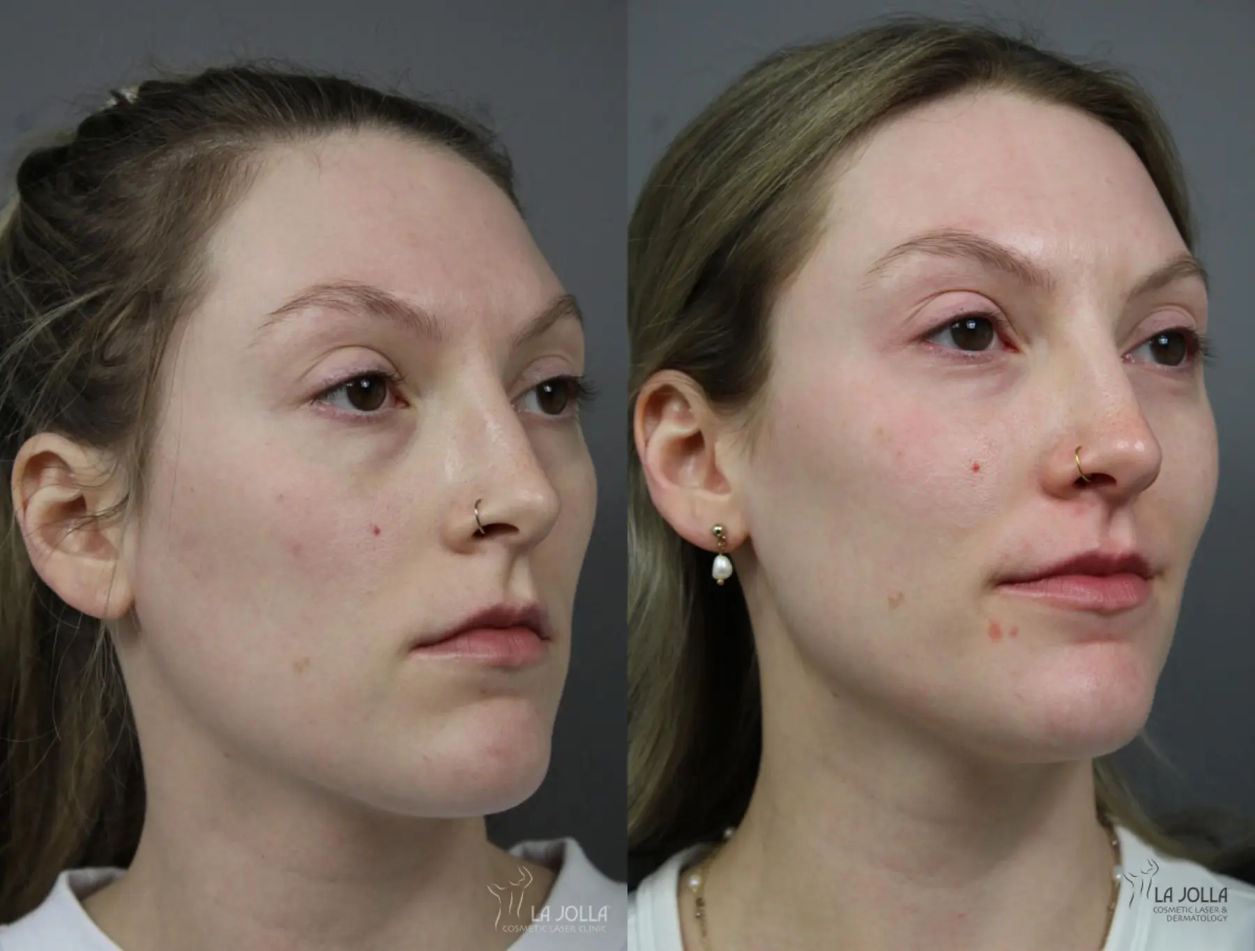 Sculptra®: Patient 2 - Before and After 2
