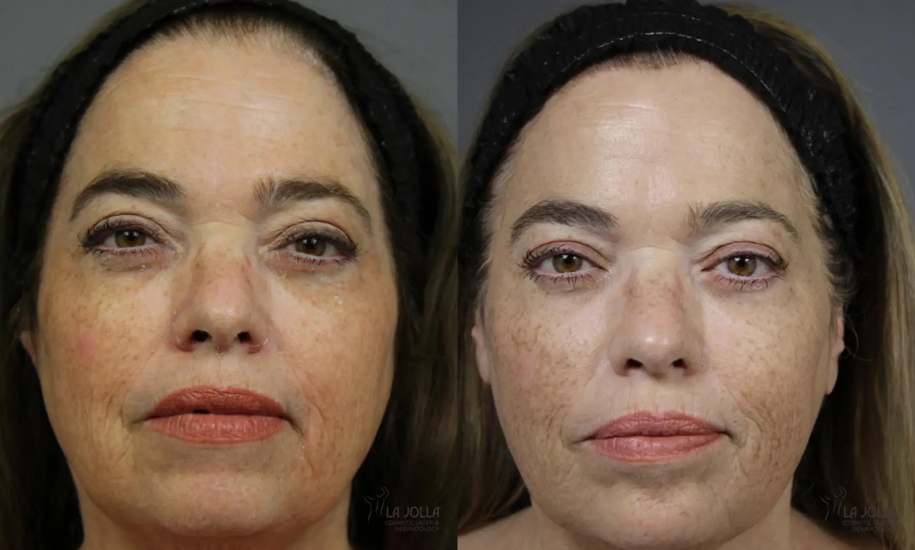 Sculptra®: Patient 1 - Before and After 1