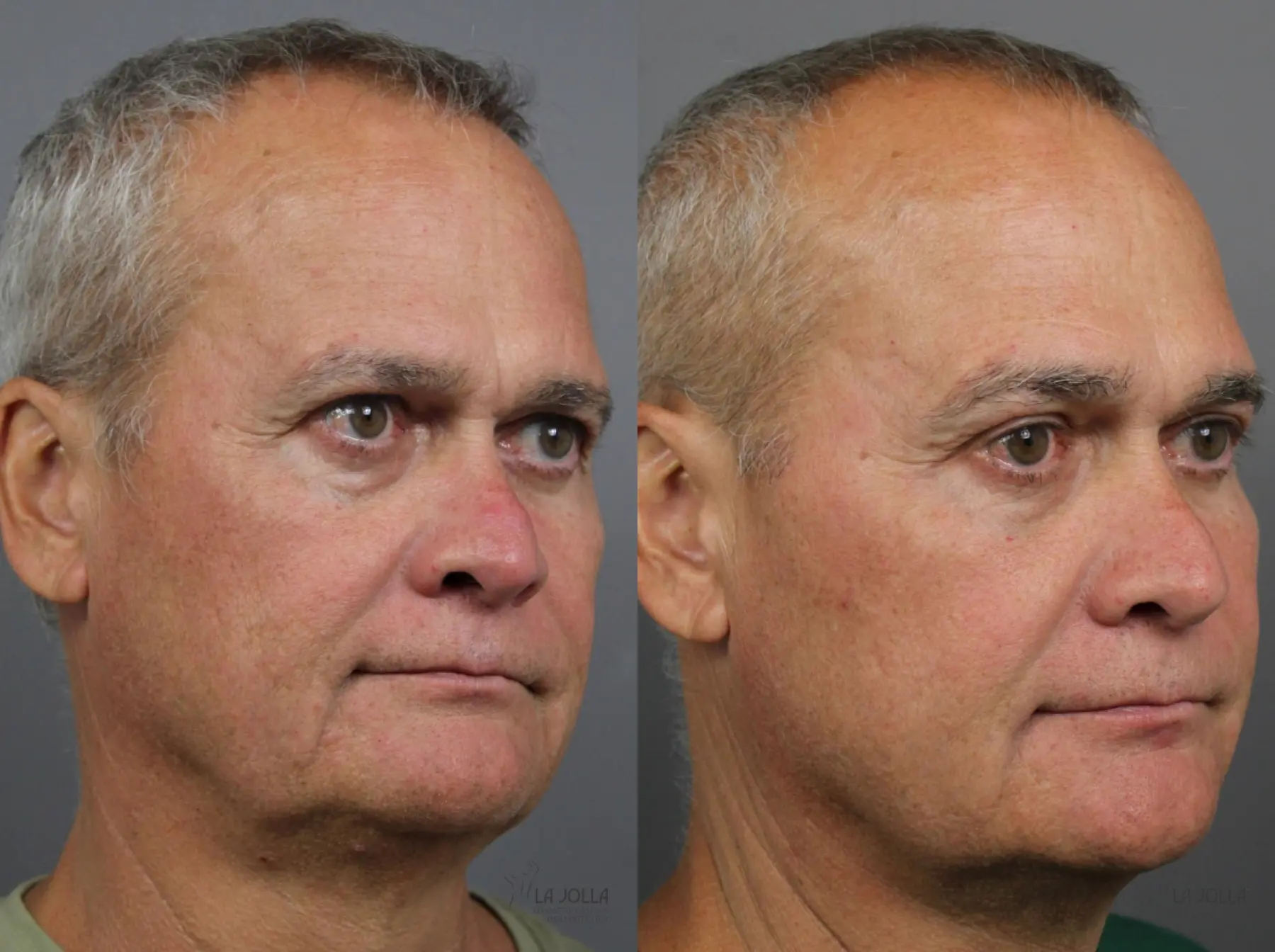 Sculptra®: Patient 3 - Before and After 3